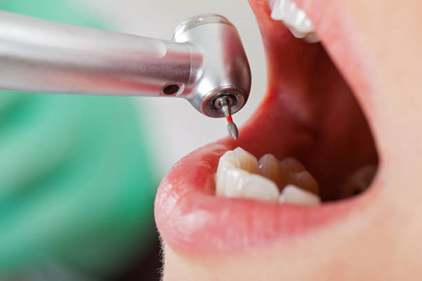 Best Emergency Wisdom Teeth Removal in Winsted, MN